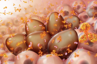 How To Cure Plasma Cell Myeloma with a Natural Approach 16