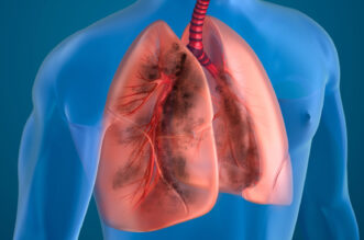 Understanding Multifocal Pneumonia: Symptoms and Treatment 2